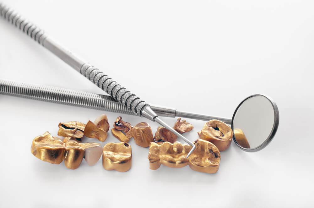 Learn how to value dental gold.